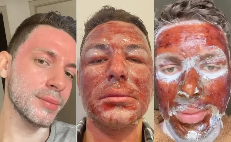 Influenciador viraliza com vídeo antes e depois da técnica com graves queimaduras no rosto; descubra detalhes